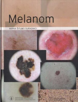 mirna Šitum i suradnici: melanom